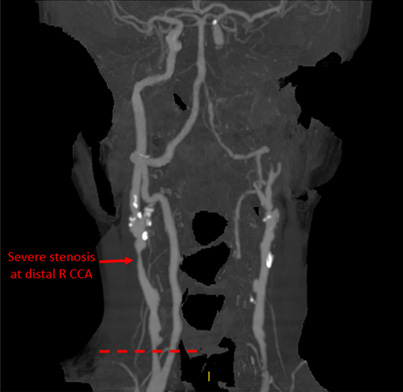 CAS Vessel Wall DWW MRI Vessel Wall