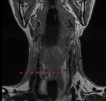 CAS Vessel Wall DWW MRI Vessel Wall