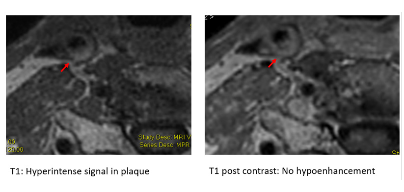 CAS Vessel Wall DWW MRI Vessel Wall
