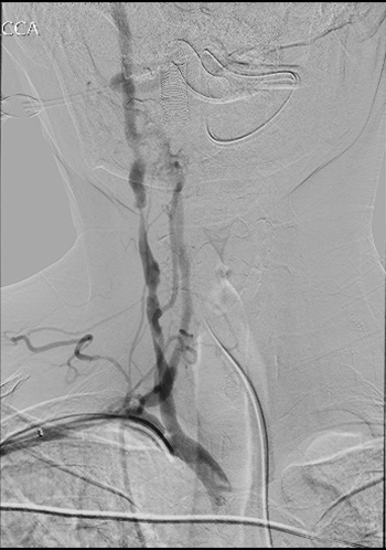 CAS Vessel Wall DWW MRI Vessel Wall