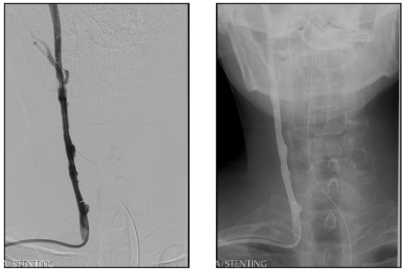 CAS Vessel Wall DWW MRI Vessel Wall
