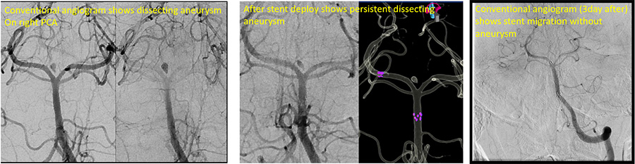 Conventional angiogram shows dissecting aneurysm  On right PCA