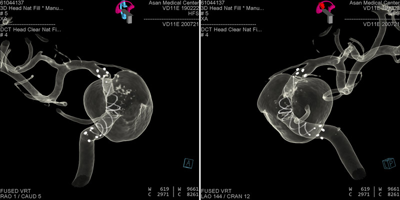 Flow diverter placement