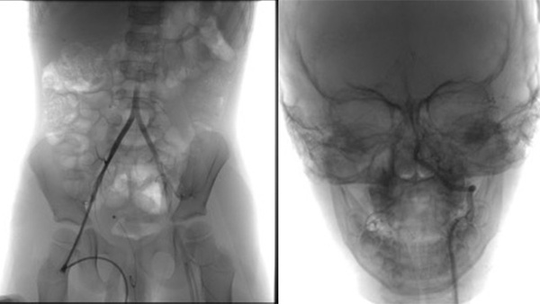 A friend in need is a friend indeed – Ischemic stroke case there SOFIA™ made all the difference