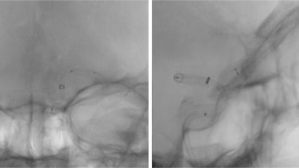 Rescue thrombectomy in post-procedural FD thrombosis
