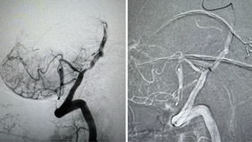 Solumbra for foreign body retrieval