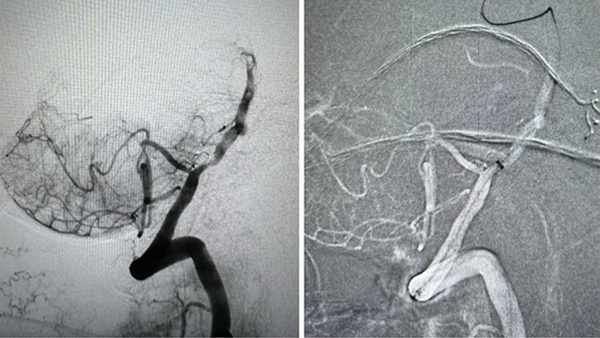Solumbra for foreign body retrieval