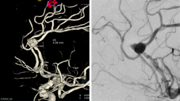 WEB + Coil of a ruptured DACA aneurysm