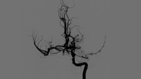 Left MCA M1 Occlusion treated with STAT technique