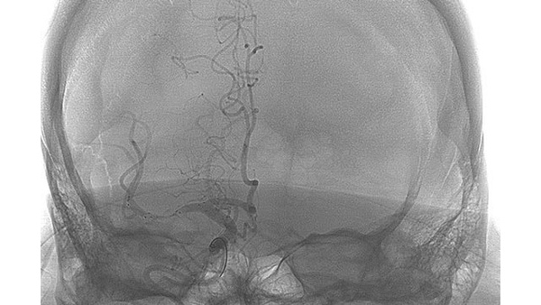 STAT technique: experience with the new Solitaire X and React aspiration catheter
