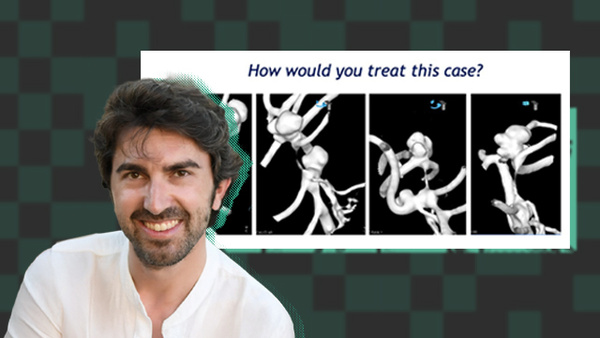 Are wide-neck and highly irregularly shaped MCA ruptured aneurysms always a good indication for surgery?