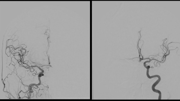 Quick Control – WEB for the Acute Treatment of a Ruptured, Irregular ACoA Aneurysm