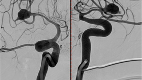 Ruptured aneurysm treated by web