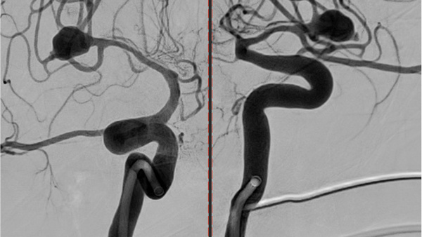 Ruptured aneurysm treated by web