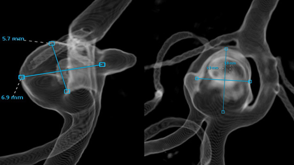 Threading the Needle: Intrasaccular WEB Device for the treatment of a Basilar Fenestration Aneurysm