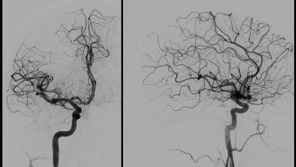 WEB Deployment in Off-Center Necks: The Added Value of Balloon Assistance