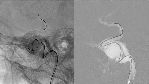 A Case of Direct Carotid Cavernous Fistula