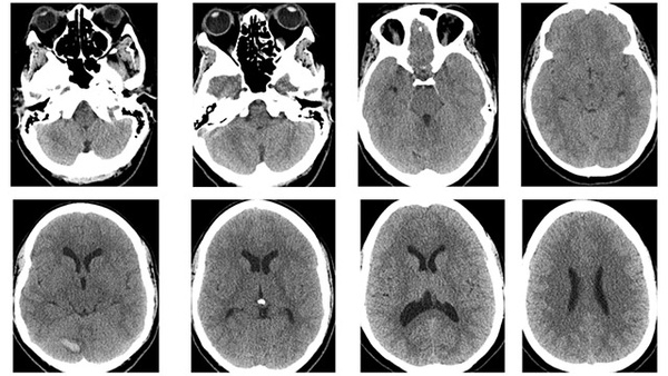 A comatose patient with fixed and dilated pupils, and a very good prognosis. The power of neuroangiography
