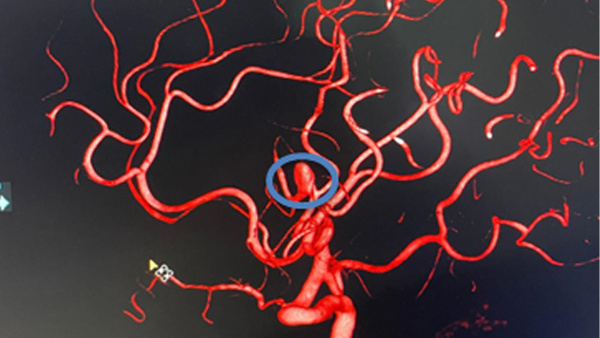 A rare case of spontaneous thrombosis in saccular cerebral aneurysm in a young adult patient