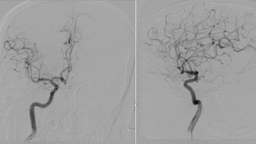 A rare complication of entrapment of a microwire with intracranial stent during stent-assisted coiling of ruptured acom aneurysm