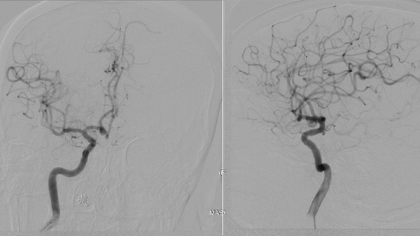 A rare complication of entrapment of a microwire with intracranial stent during stent-assisted coiling of ruptured acom aneurysm