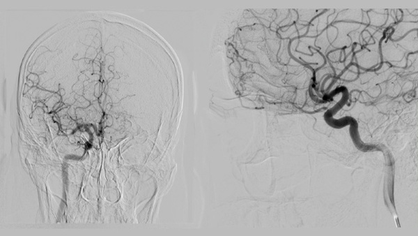 A twist of fate: the spontaneous closure of an AV fistula