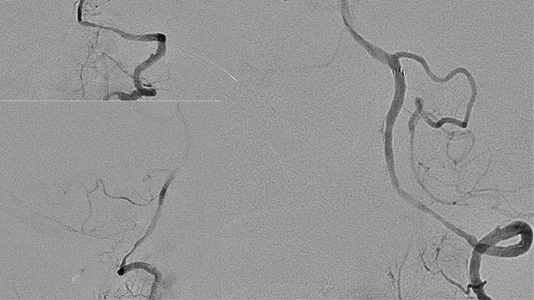 AComA Crossover Treatment of a Complex ICA Tip Aneurysm Using pEGASUS HPC stent