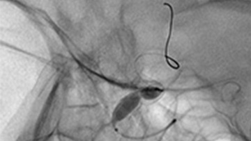Acute FDS twisting and its management