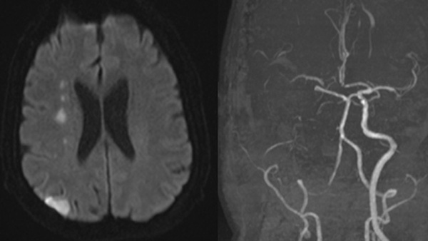Acute ICA occlusions with patent intracranial circulation : when to intervene