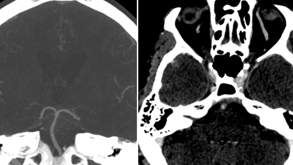 Acute treatment of a ruptured cerebral aneurysm with a flow-diversion stent