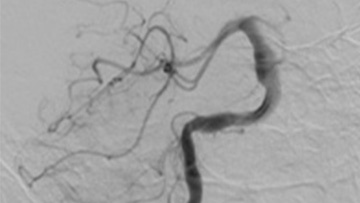 11-acute-treatment-of-ruptured-fusiform-basilar-aneurysm-teaser