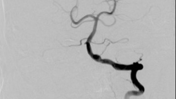 Acute Treatment of ruptured fusiform V4 aneurysm 