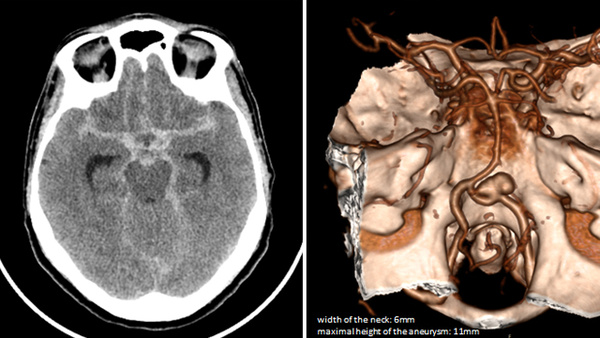 Where there is a will, there is a way: acute treatment of V4 aneurysm with FD by retrograde approach
