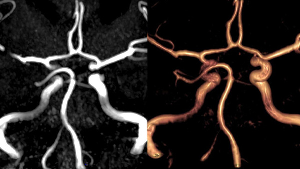 P1 occlusion 