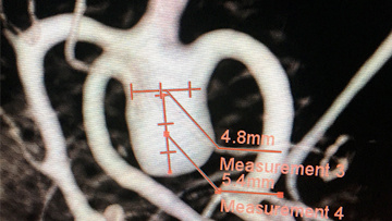 MCA aneurysm