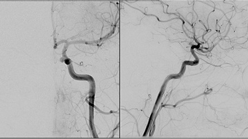 Aneurysm on left ICA in carotid cave segment