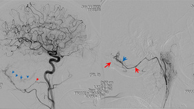 Approach to an Infratentorial Dural Arteriovenous Fistula - The Third time is the charm !