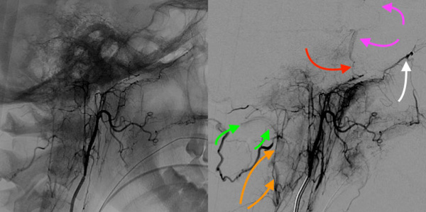 Ascending pharyngeal with its “dangerous” anastomoses