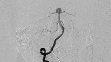 Basilar artery aneurysm