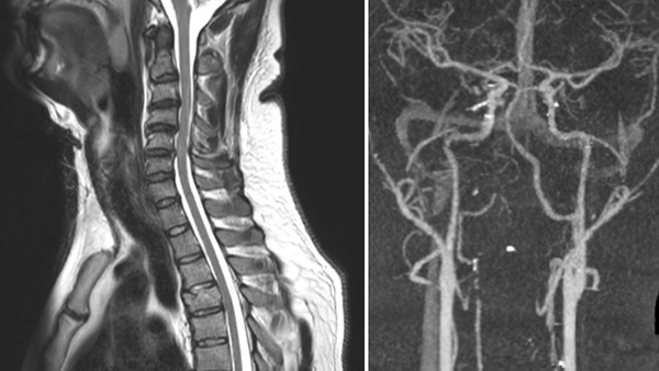 Basilar artery clot retrieval for stroke due to traumatic vertebral artery injury. A case report