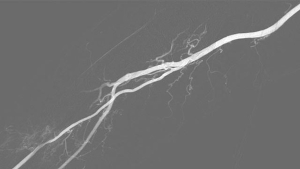 Basilar artery occlusion recanalized with thrombectomy, PTA and stenting via right transradial access