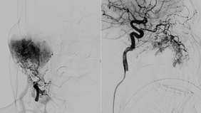Bleomycin Electro Sclerotherapy as curative biological approach for craniofacial high flow arteriovenous malformations – first case experience