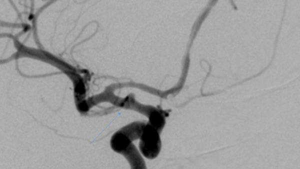Blood blister aneurysm