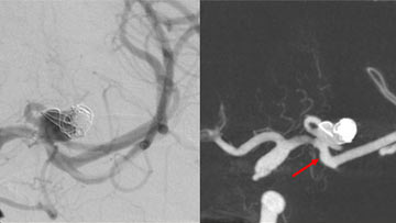 Bridging the neck: eCLIPS for a previously ruptured middle cerebral artery aneurysm