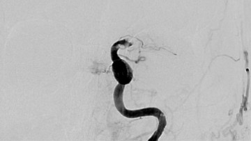Carotid terminus occlusion treated with TIGER XL device