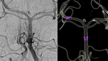 A case of early intracranial stent migration after treatment of a dissecting aneurysm