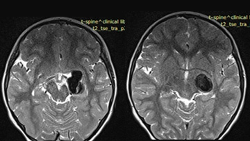 Case of thrombectomy of acute occluded flow diverter