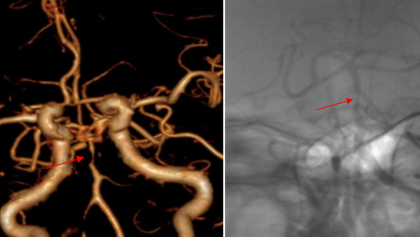 Cerebro angioplasty and stenting after IV-TPA in AIS