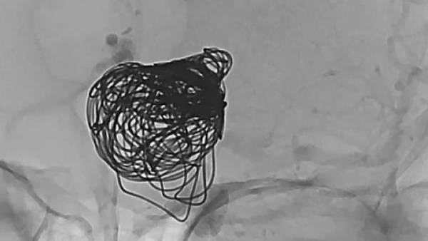 Challenges with staged treatment of a ruptured giant aneurysm