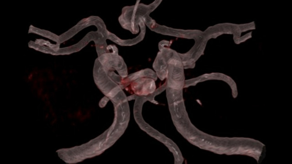 Complex anterior communicating artery (ACoA) aneurysm treatment with two kissing Pipeline™ Vantage with Shield technology and RIST™ radial system